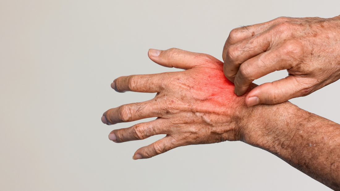 Deux mains disposées sur un fond gris. Une d'elles gratte l'autre à cause de l'eczéma.